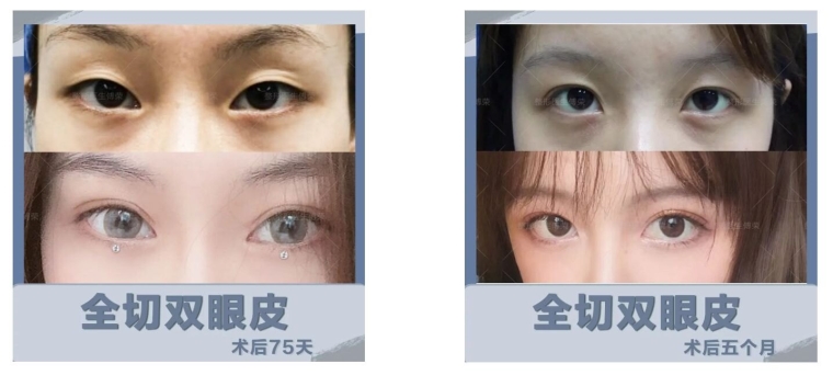 老医生给你说天津缝线双眼皮能吗 老医生给你说天津缝线双眼皮能吗