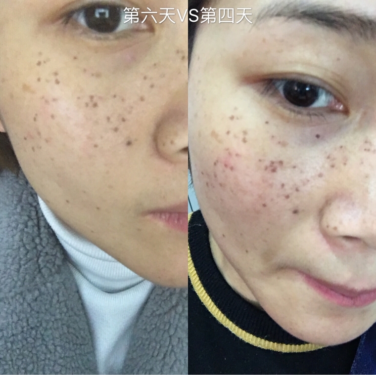 大师今天说下南京激光祛除雀斑效果怎么样 大师今天说下南京激光祛除雀斑效果怎么样