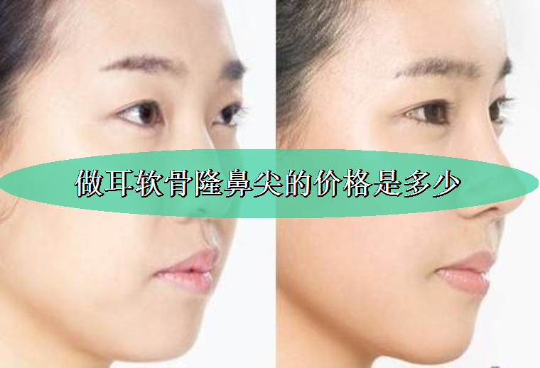 今日来谈谈做耳软骨隆鼻尖的价格是多少,隆鼻 今日来谈谈做耳软骨隆鼻尖的价格是多少,隆鼻