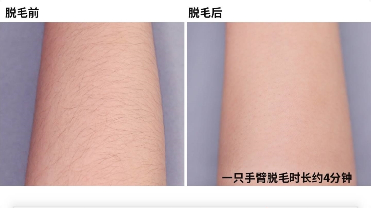 编辑告诉你常州激光脱毛效果怎么样 编辑告诉你常州激光脱毛效果怎么样