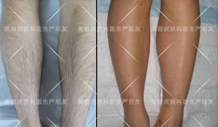 编辑告诉你常州激光脱毛效果怎么样 编辑告诉你常州激光脱毛效果怎么样