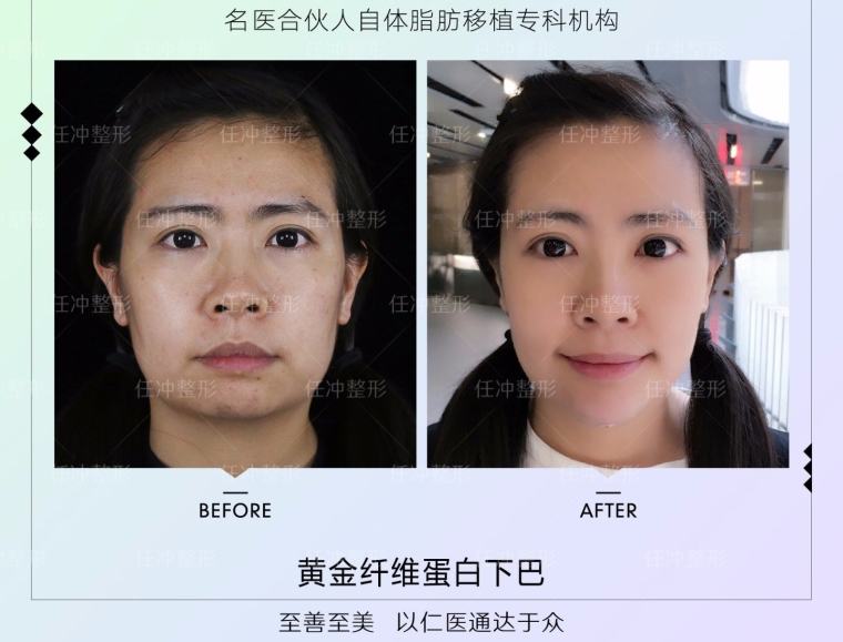 经验人士给你说苏州自体脂肪填充面部安全吗 经验人士给你说苏州自体脂肪填充面部安全吗