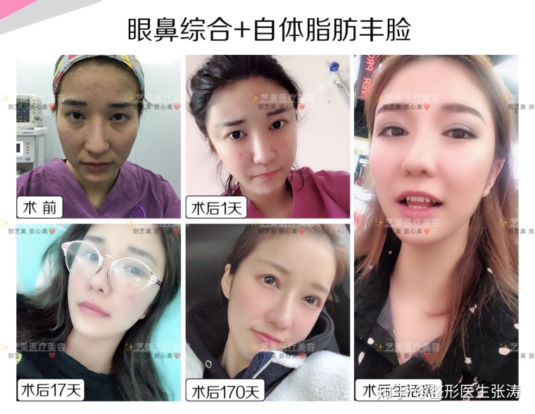 经验人士给你说苏州自体脂肪填充面部安全吗 经验人士给你说苏州自体脂肪填充面部安全吗