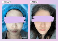 咱们来聊聊天津垫鼻子疼吗