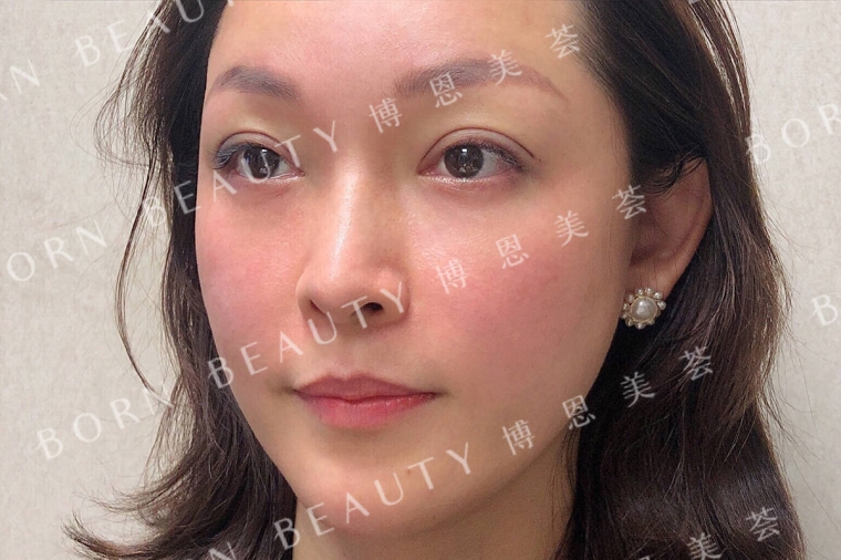 小编来聊聊广州假体垫下巴一个月还没恢复正常吗 小编来聊聊广州假体垫下巴一个月还没恢复正常吗