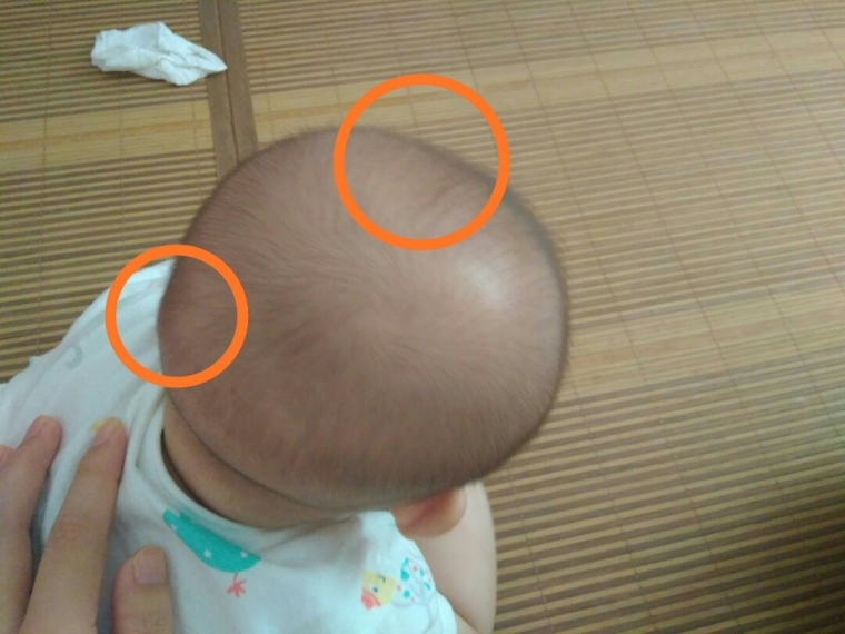 小编来聊聊广州假体垫下巴一个月还没恢复正常吗 小编来聊聊广州假体垫下巴一个月还没恢复正常吗