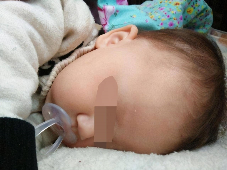 小编来聊聊广州假体垫下巴一个月还没恢复正常吗 小编来聊聊广州假体垫下巴一个月还没恢复正常吗