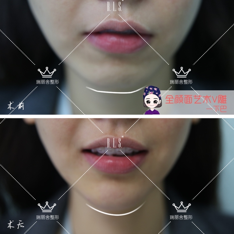 爱美人士聊广州假体垫下巴一个月还没恢复正常吗 爱美人士聊广州假体垫下巴一个月还没恢复正常吗