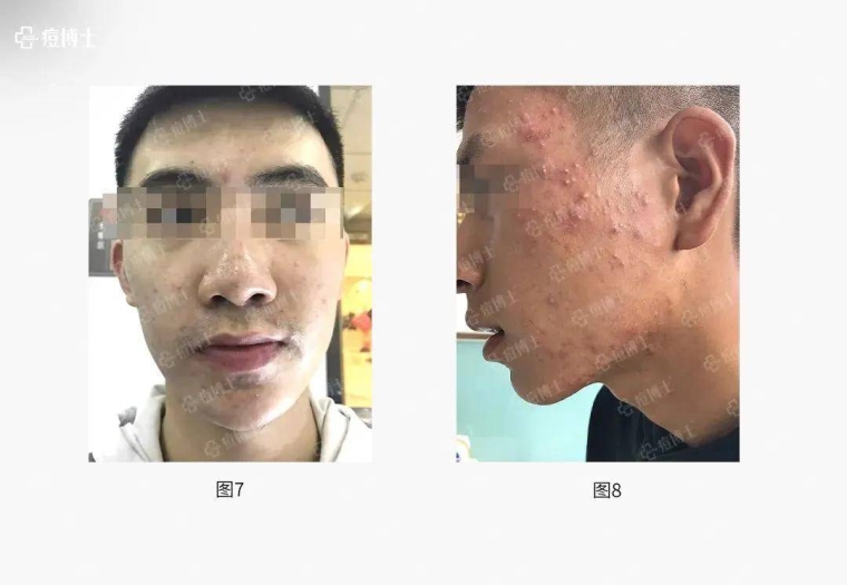 桃子姐聊聊为什么会长痘痘,有哪些危害 桃子姐聊聊为什么会长痘痘,有哪些危害