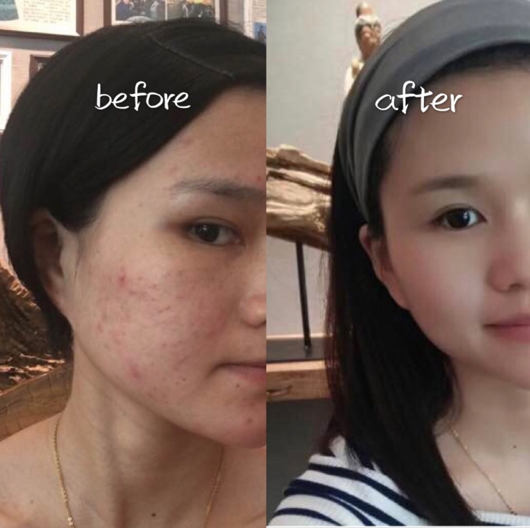 桃子姐聊聊为什么会长痘痘,有哪些危害 桃子姐聊聊为什么会长痘痘,有哪些危害