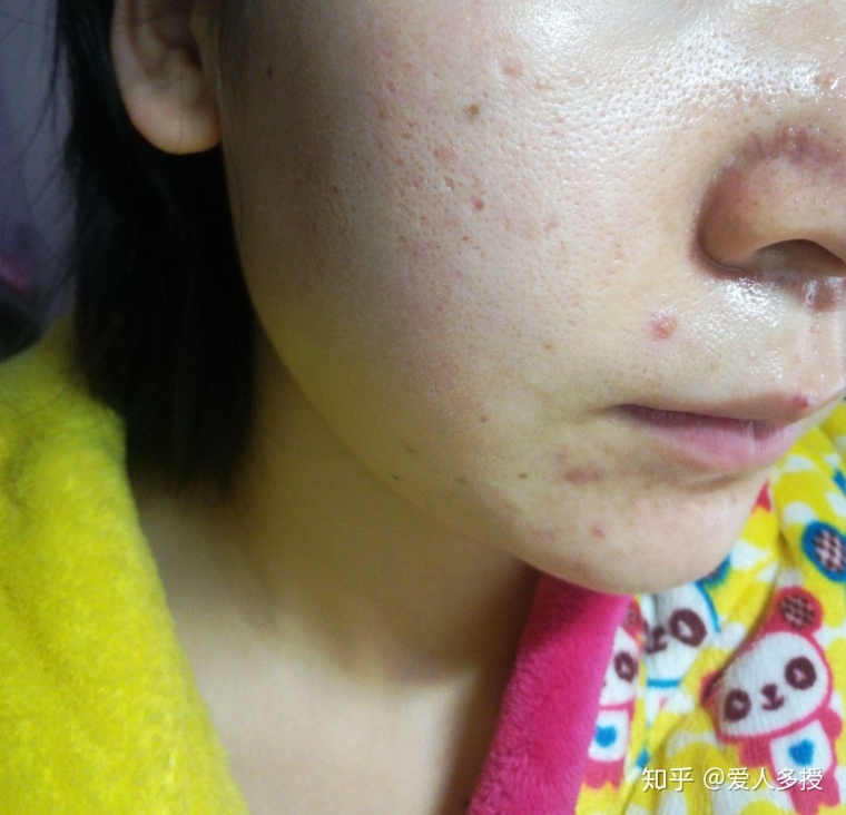 大神解答沈阳激光祛痘术后怎么调理 大神解答沈阳激光祛痘术后怎么调理