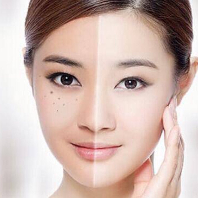 主编告诉你苏州皮秒激光祛斑几次见效 主编告诉你苏州皮秒激光祛斑几次见效