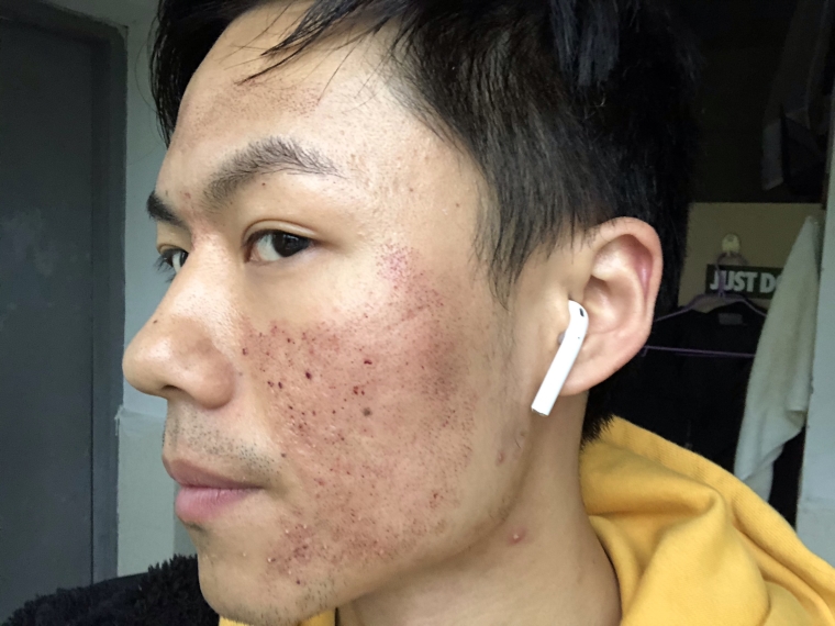 老司机谈谈点阵激光需要多少钱 老司机谈谈点阵激光需要多少钱