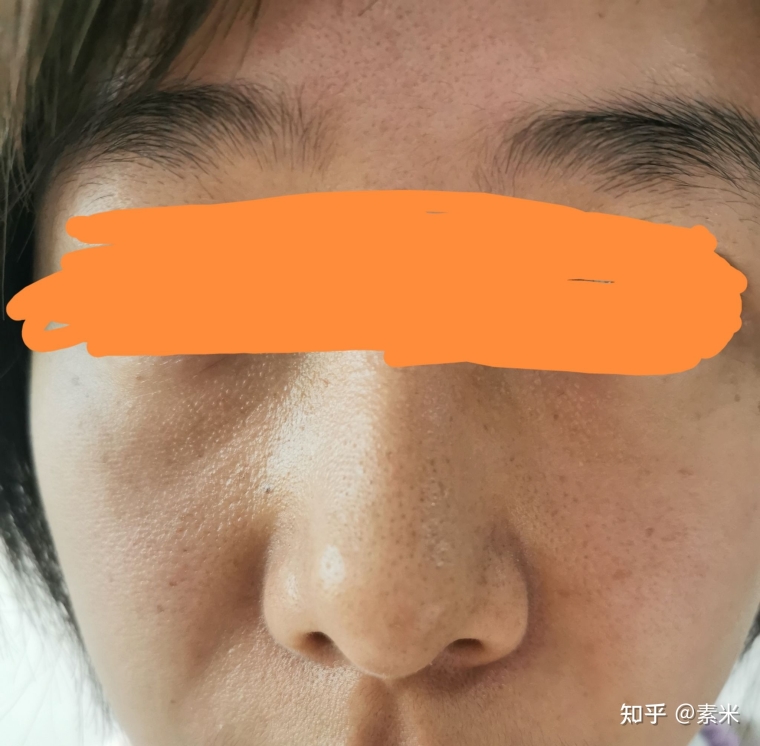 老司机谈谈点阵激光需要多少钱 老司机谈谈点阵激光需要多少钱