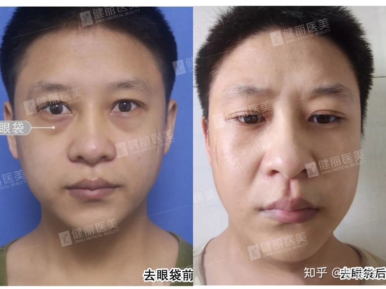 大师今天说下激光祛疤手术多少钱 大师今天说下激光祛疤手术多少钱