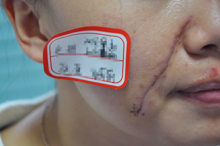 大师今天说下激光祛疤手术多少钱 大师今天说下激光祛疤手术多少钱