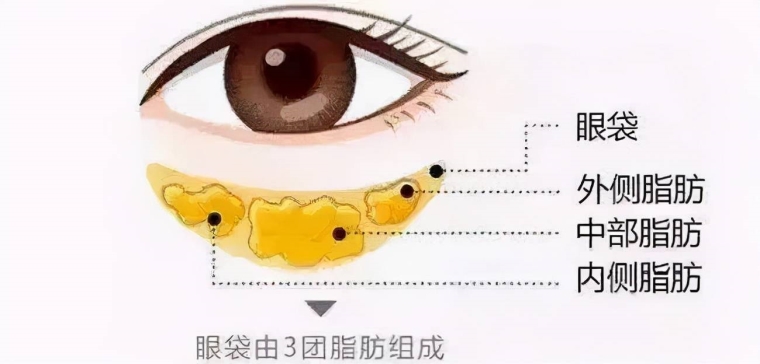 编辑给你说祛眼袋的方法有哪些 编辑给你说祛眼袋的方法有哪些