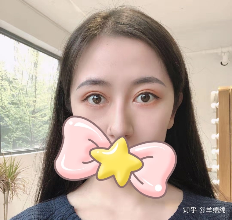 今日来聊聊埋线双眼皮价格多少 今日来聊聊埋线双眼皮价格多少