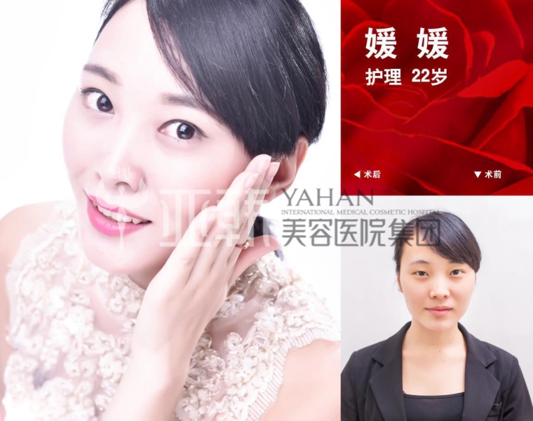 今日来聊聊埋线双眼皮价格多少 今日来聊聊埋线双眼皮价格多少