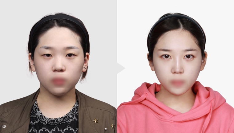 今日来聊聊埋线双眼皮价格多少 今日来聊聊埋线双眼皮价格多少