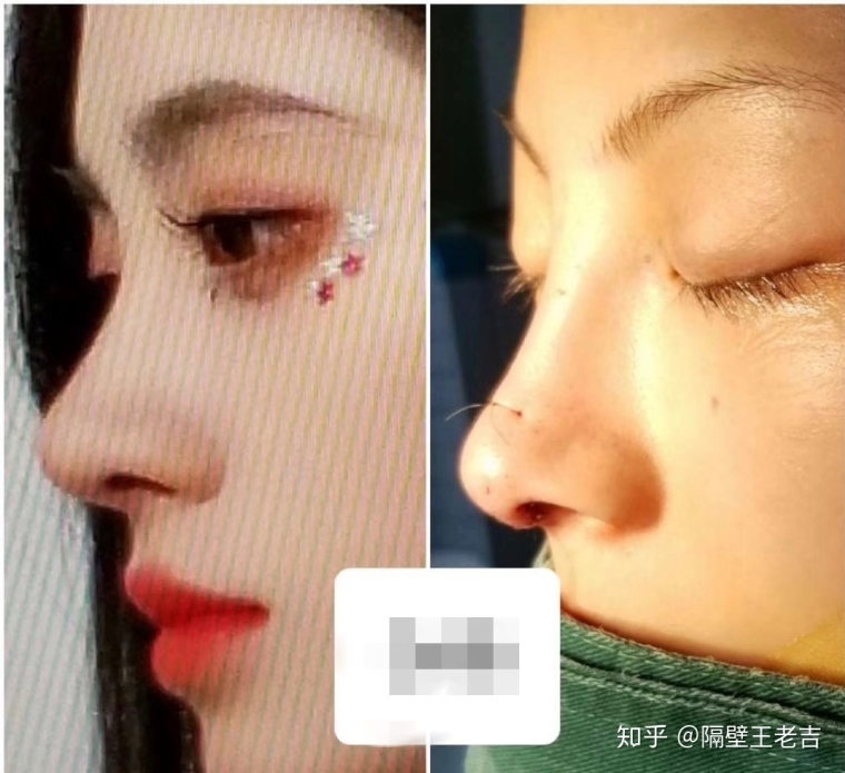 关于解答广州隆鼻哪种好 关于解答广州隆鼻哪种好