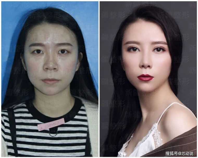 关于解答广州隆鼻哪种好 关于解答广州隆鼻哪种好