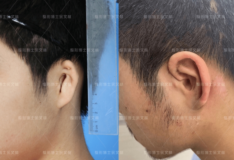 关于解答广州隆鼻哪种好 关于解答广州隆鼻哪种好