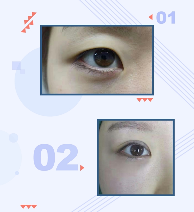 笔者说说上海去眼袋手术后多久见效 笔者说说上海去眼袋手术后多久见效