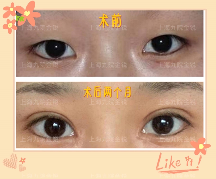 老司机给你说双眼皮手术效果怎么样 老司机给你说双眼皮手术效果怎么样