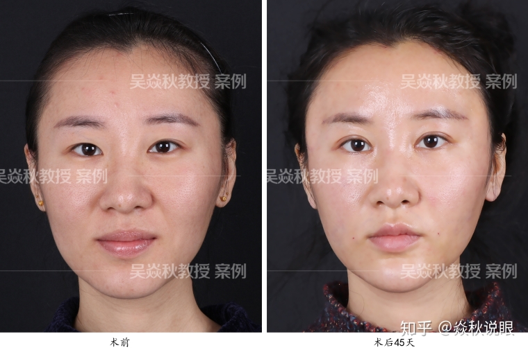 老司机给你说双眼皮手术效果怎么样 老司机给你说双眼皮手术效果怎么样