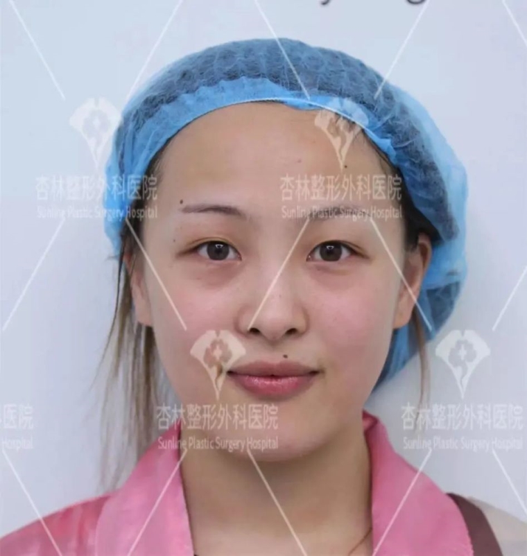 老司机给你说双眼皮手术效果怎么样 老司机给你说双眼皮手术效果怎么样