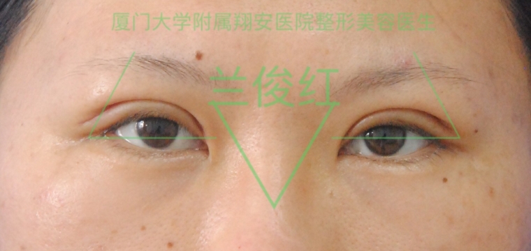 咱们来聊聊双眼皮手术效果怎么样 咱们来聊聊双眼皮手术效果怎么样