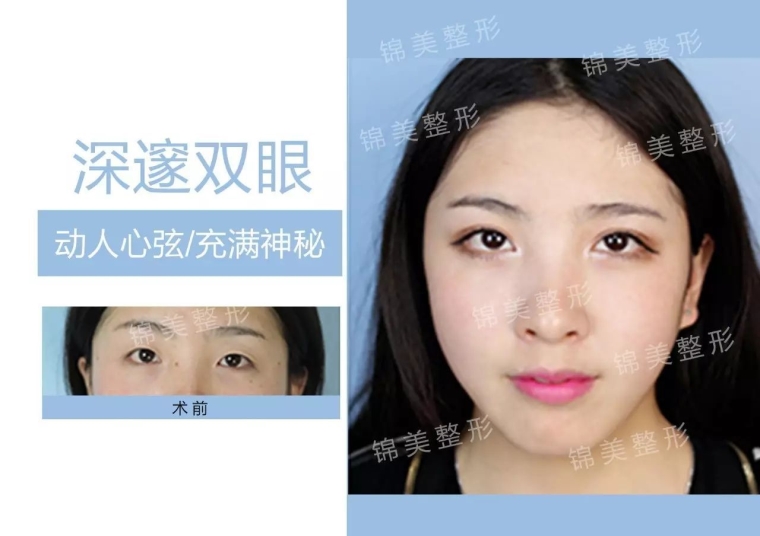 咱们来聊聊双眼皮手术效果怎么样 咱们来聊聊双眼皮手术效果怎么样