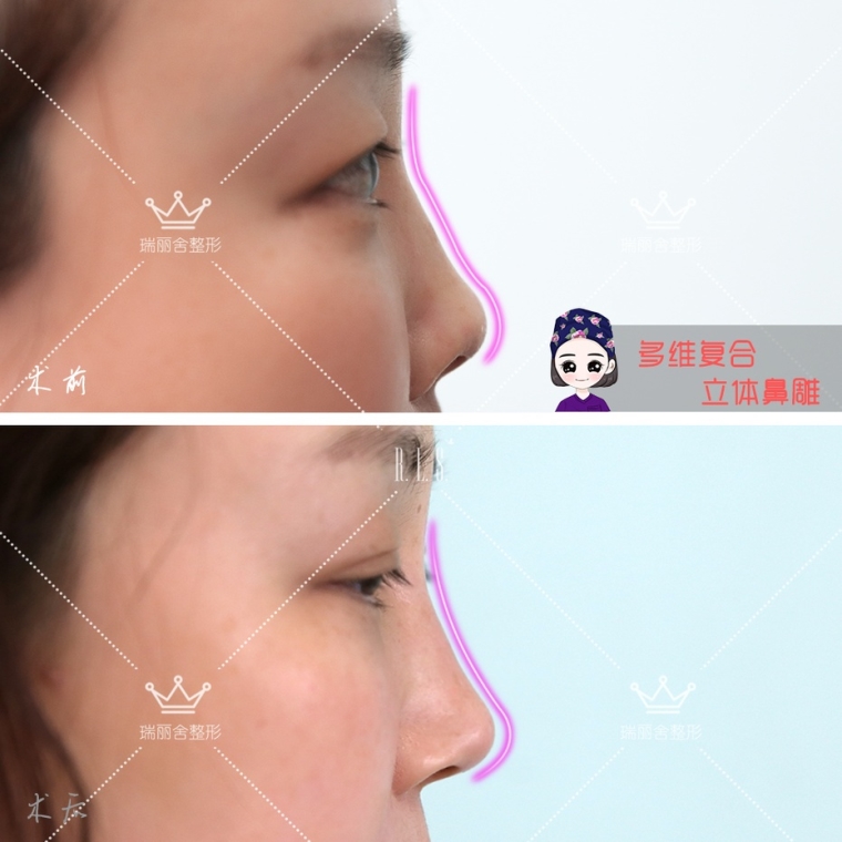 老医生给你说假体隆下巴费用要多少呢 老医生给你说假体隆下巴费用要多少呢