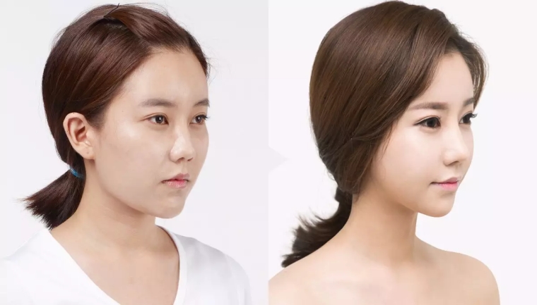 小编今天说说广州做假体隆鼻手术会不会伤害到身体呢 小编今天说说广州做假体隆鼻手术会不会伤害到身体呢