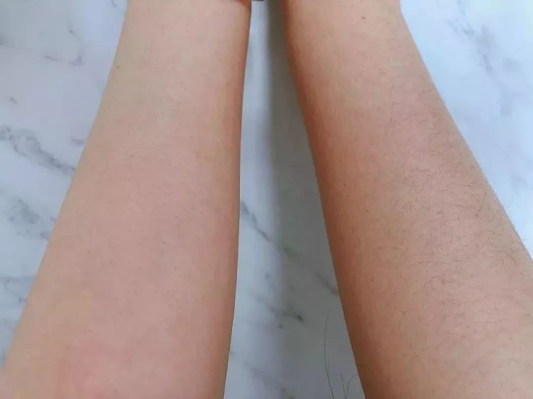 谈一谈广州激光脱手臂汗毛效果怎么样 谈一谈广州激光脱手臂汗毛效果怎么样