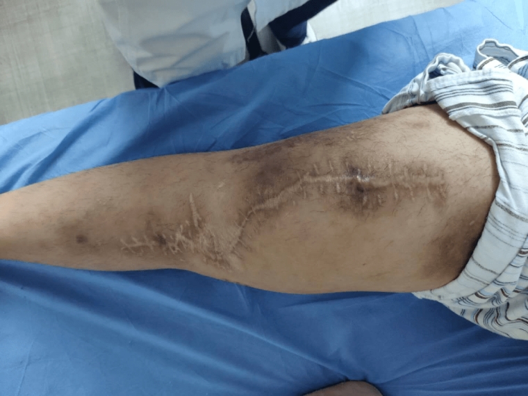 谈一谈广州激光脱手臂汗毛效果怎么样 谈一谈广州激光脱手臂汗毛效果怎么样