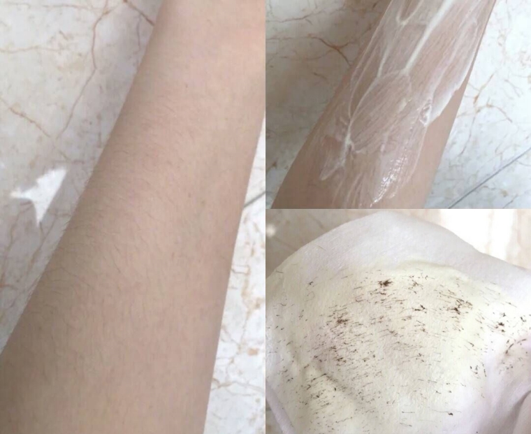 谈一谈广州激光脱手臂汗毛效果怎么样 谈一谈广州激光脱手臂汗毛效果怎么样