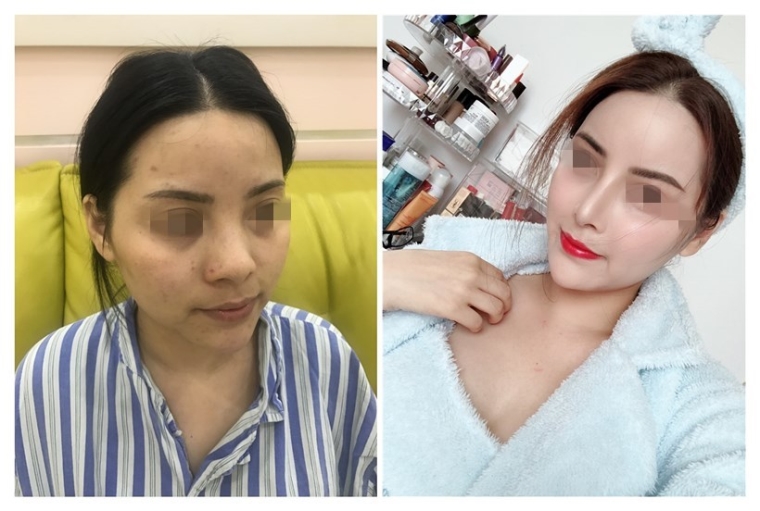 美容师说说广州假体隆鼻手术会有年龄限制吗 美容师说说广州假体隆鼻手术会有年龄限制吗