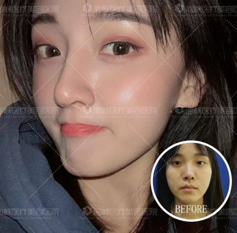 美容师说说广州假体隆鼻手术会有年龄限制吗 美容师说说广州假体隆鼻手术会有年龄限制吗