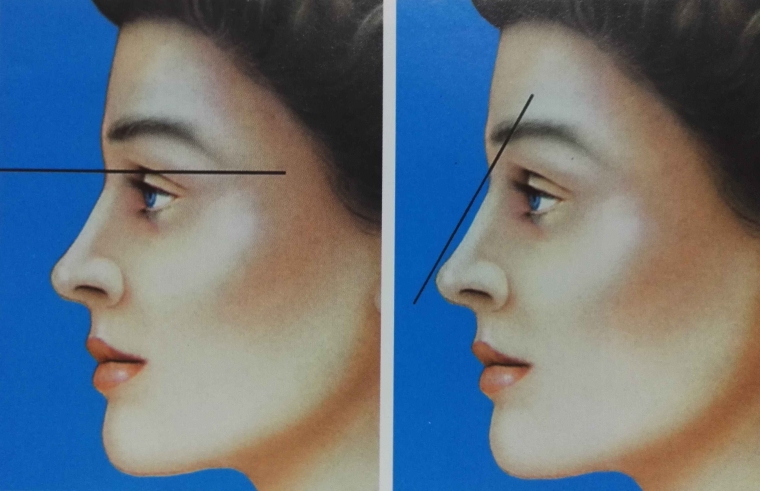 桃子姐给你说说广州玻尿酸丰下巴有哪些优势呢 桃子姐给你说说广州玻尿酸丰下巴有哪些优势呢