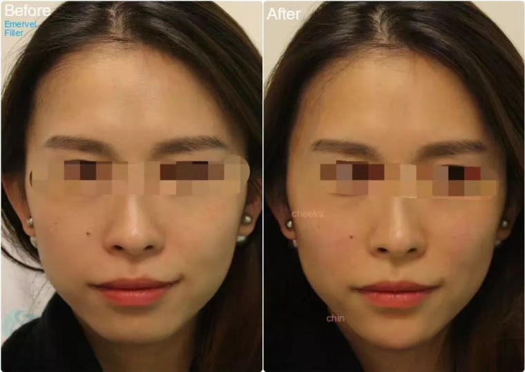 桃子姐给你说说广州玻尿酸丰下巴有哪些优势呢 桃子姐给你说说广州玻尿酸丰下巴有哪些优势呢