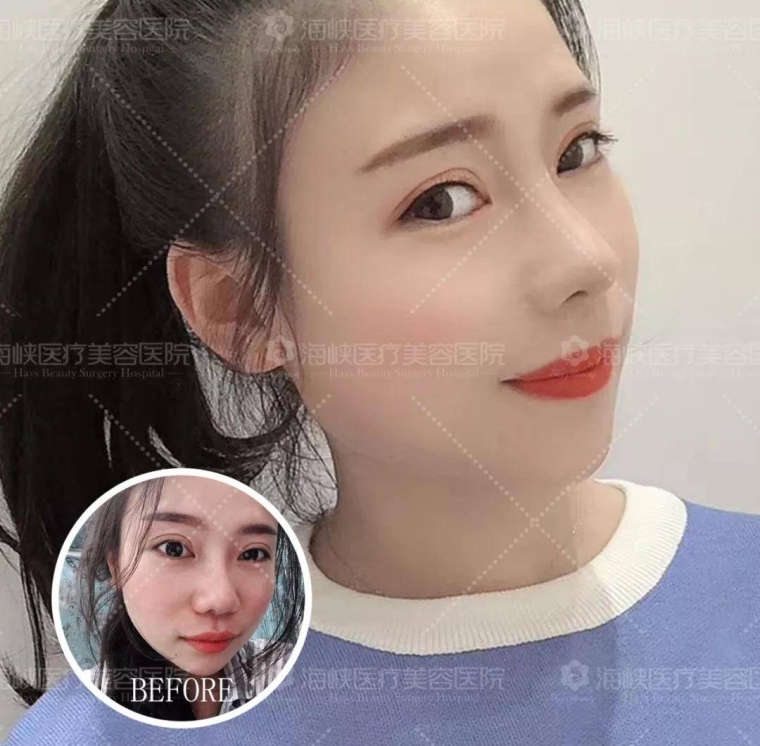 美容师说说广州假体隆鼻手术会有年龄限制吗 美容师说说广州假体隆鼻手术会有年龄限制吗