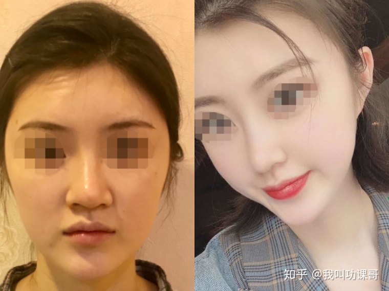 美容师说说广州假体隆鼻手术会有年龄限制吗 美容师说说广州假体隆鼻手术会有年龄限制吗