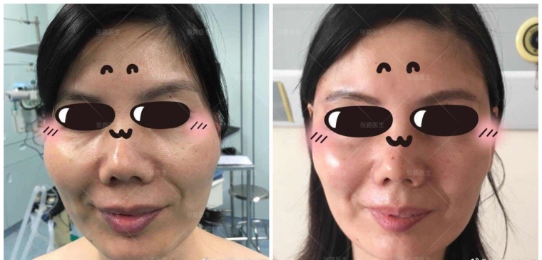 今日来聊聊广州玻尿酸填充面部有哪些危害 今日来聊聊广州玻尿酸填充面部有哪些危害