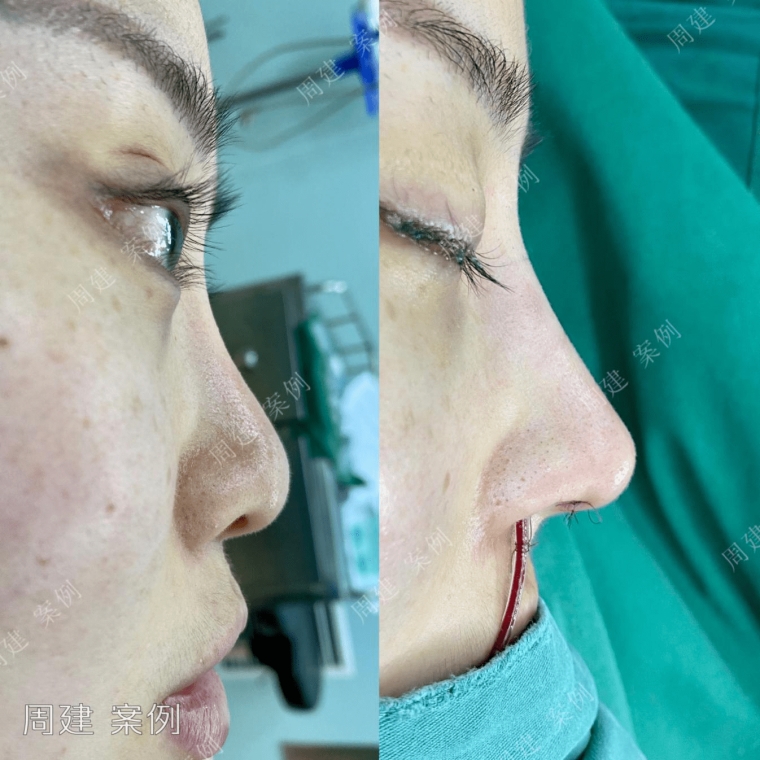 今日解说广州假体垫下巴后取出假体难度大吗 今日解说广州假体垫下巴后取出假体难度大吗