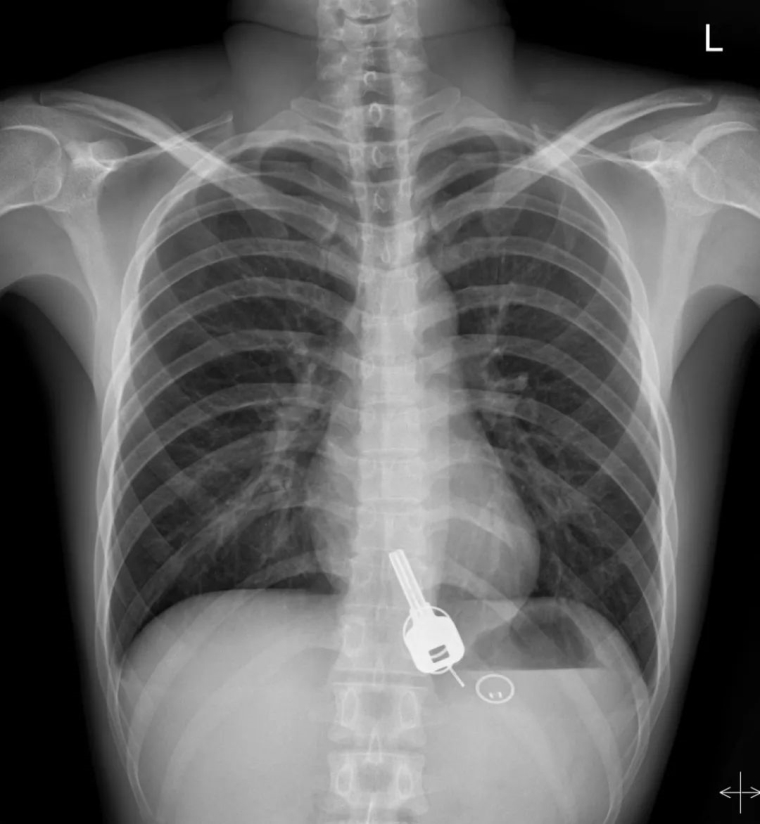 今日解说广州假体垫下巴后取出假体难度大吗 今日解说广州假体垫下巴后取出假体难度大吗