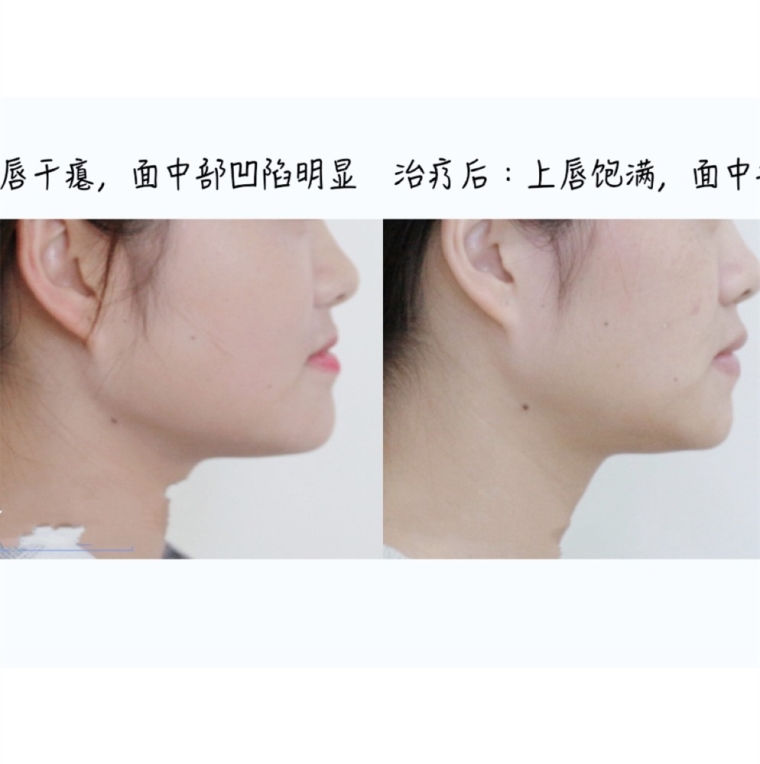 编辑来谈谈矫正牙齿有年龄限制吗 编辑来谈谈矫正牙齿有年龄限制吗