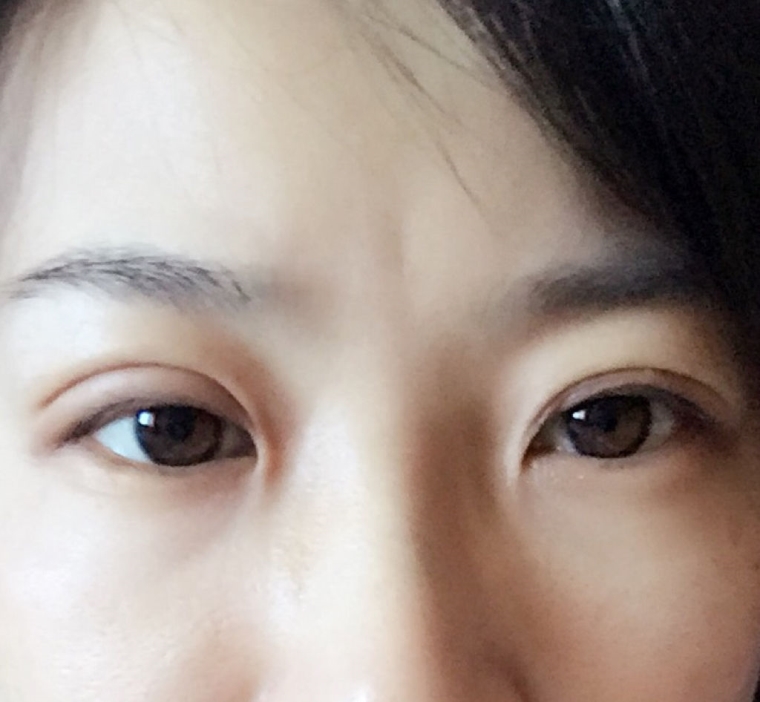 关于一些佛山割双眼皮哪家医院好 关于一些佛山割双眼皮哪家医院好