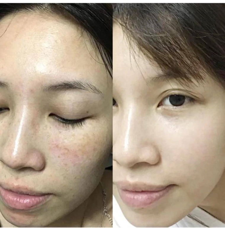 小编今天说说北京老年人能做激光祛斑吗 小编今天说说北京老年人能做激光祛斑吗